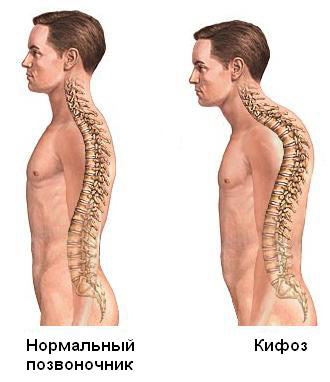 Кифоз